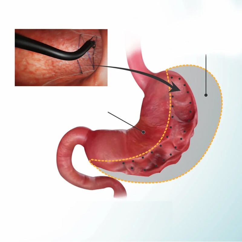 Endoscopic sleeve gastroplasty Turkey price